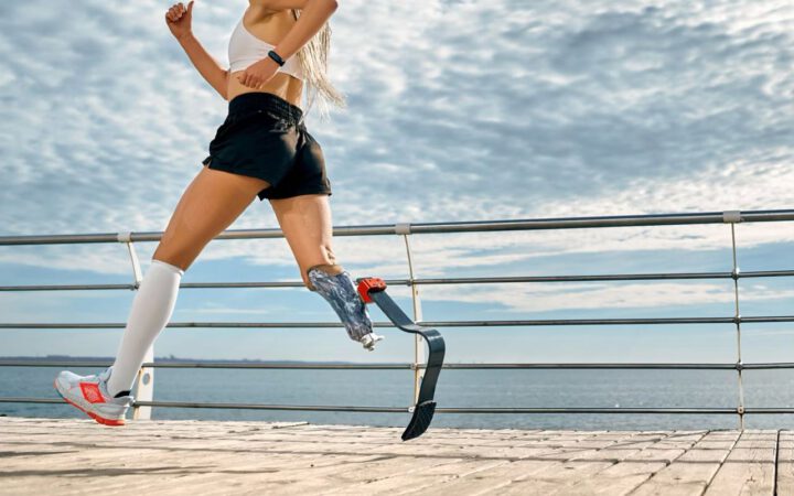A woman with a prosthetic leg