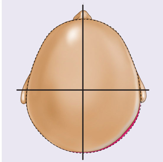 Type I infant cranial deformation