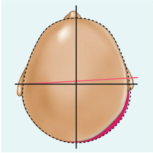 Type II infant cranial deformation