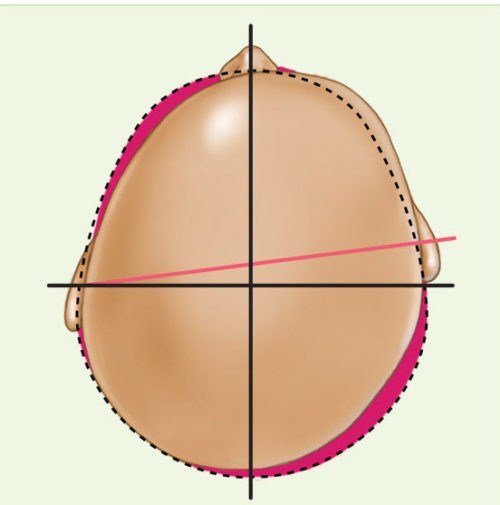 Type III infant cranial deformation