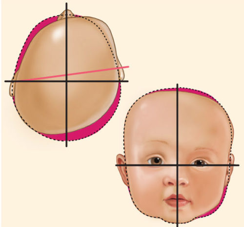 Type V infant cranial deformation