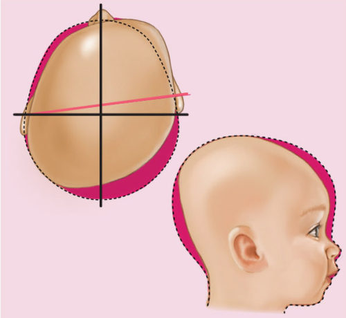 Type V infant cranial deformation