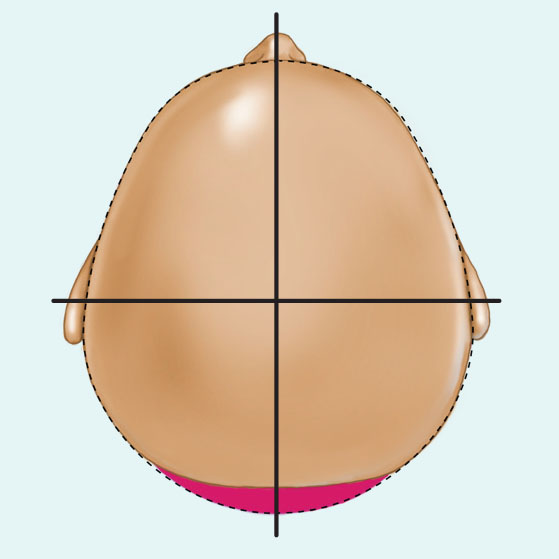 Type I infant deformational brachycephaly