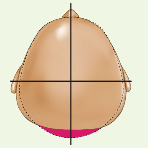 Type II infant deformational brachycephaly