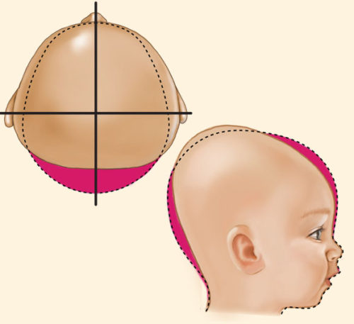 Type III infant deformational brachycephaly