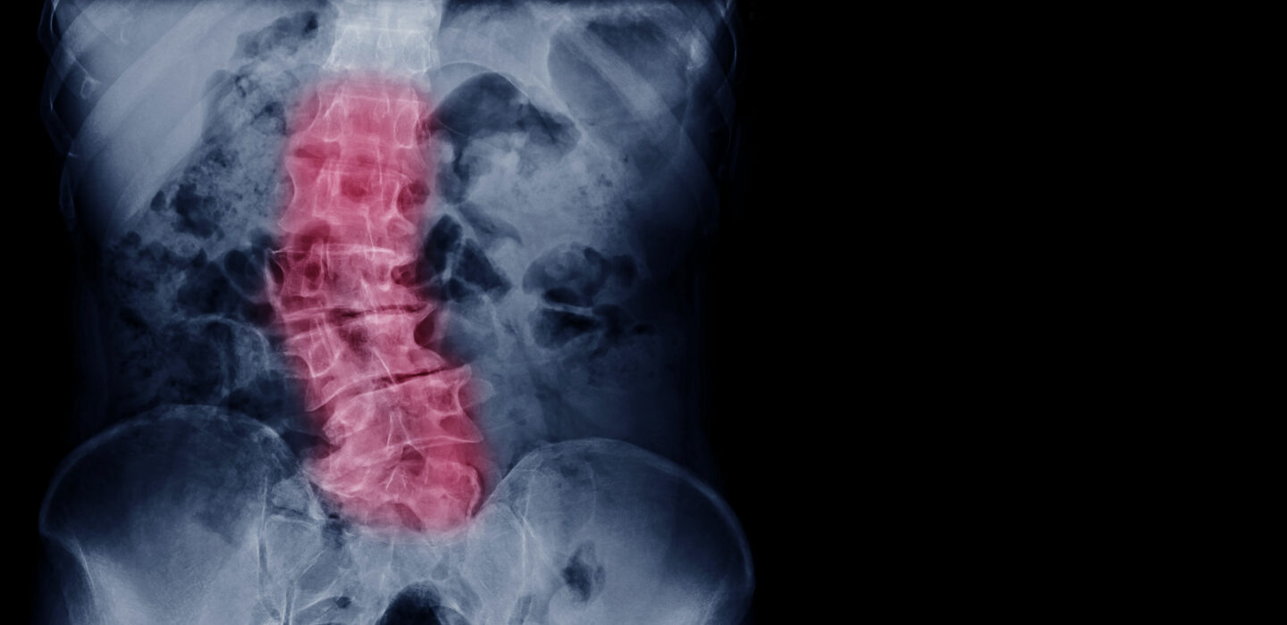 X ray image of elder patient spine show scoliosis and spinal bend in old people. process in blue tone spine mark in red color and have copy space, medical concept.